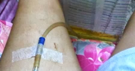 iniezioni dimagranti di proteine iniezioni dimagranti di proteine